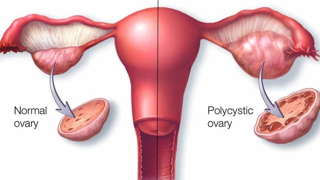 Polikistik Over Sendromu (PCOS): Kadınlarda Sık Görülen Hormonal Dengesizlik